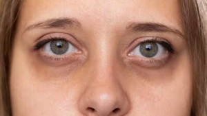 Headline:
Under-Eye Dark Circles: Are They a Sign of Kidney, Liver Problems, or Something Else?
