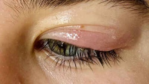 Eyelid Disorders: A Comprehensive Guide to Causes, Symptoms, Diagnosis, and Treatment