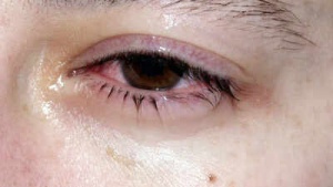Morning Eye Crust: Causes, Relief, and When to See a Doctor