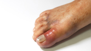 High Uric Acid and Your Skin: Key Signs to Watch For
