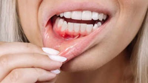 Persistent Bleeding Gums? 8 Medical Conditions You Shouldn't Ignore