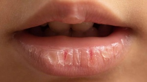 Chapped Lips SOS: Relief, Causes, and Natural Remedies for a Healthy Pout