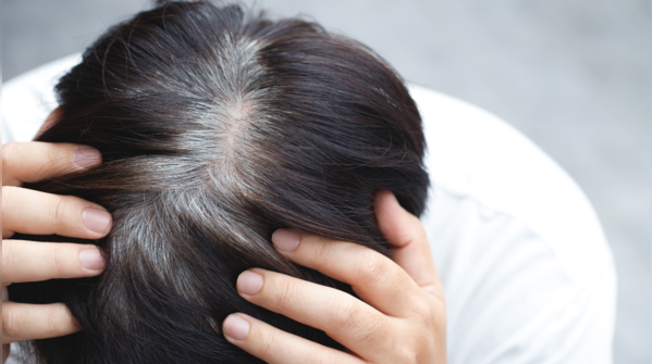 Premature greying of hair
