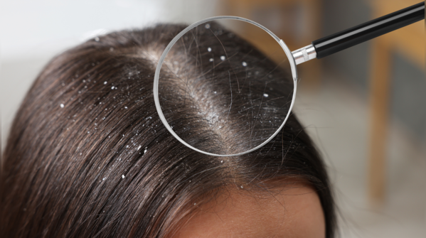 Excessive dandruff