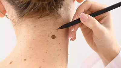 6 early melanoma signs that reveal hidden skin cancer risks